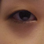 4岁女孩黑眼圈一直不退 送医竟查出高危恶性肿瘤